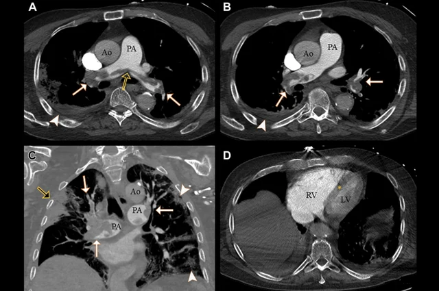 RSNA STR Pulmonary Embolism Detection — research illustration